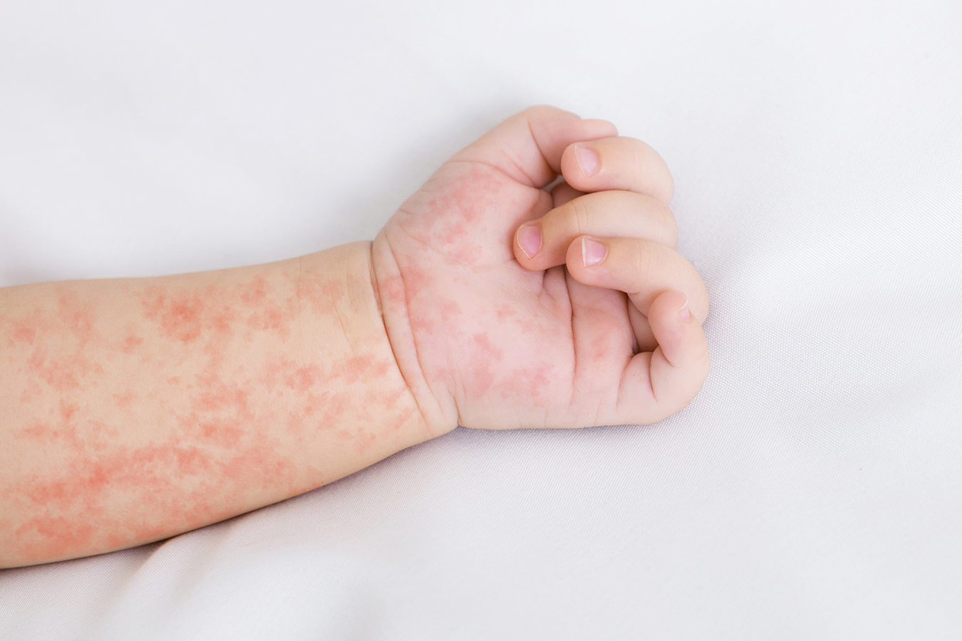An infant's arm with a measles rash